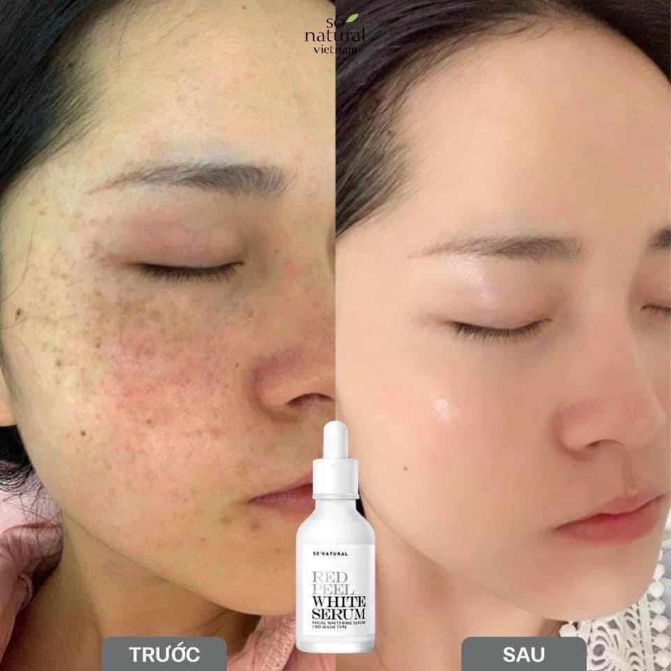 Red peel white serum