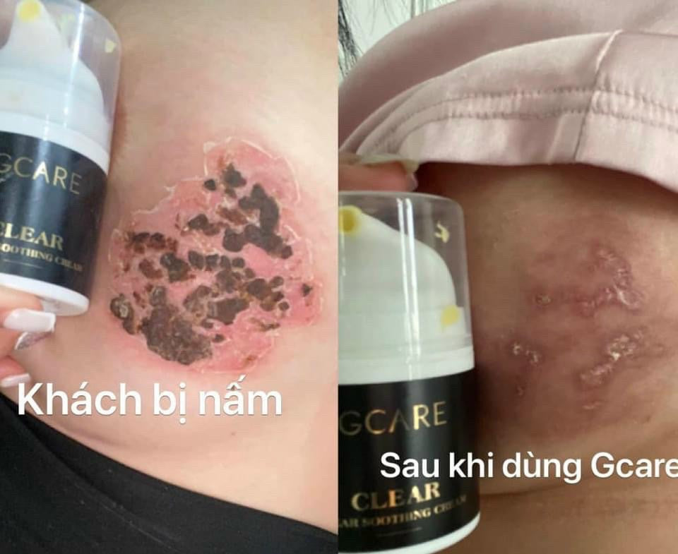 Gcare Kem viem da