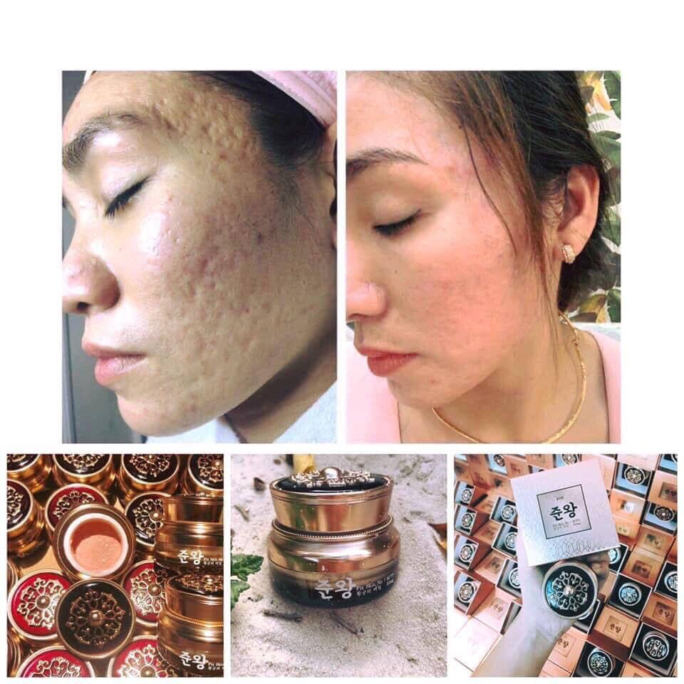 Kem tri rổ Genie SCAR- ACNE SCAR TREATMENT Korean Cream MADE IN KOREA