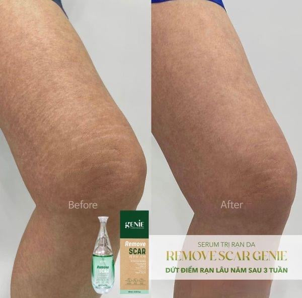 Serum tri ran da Remove Scar genie