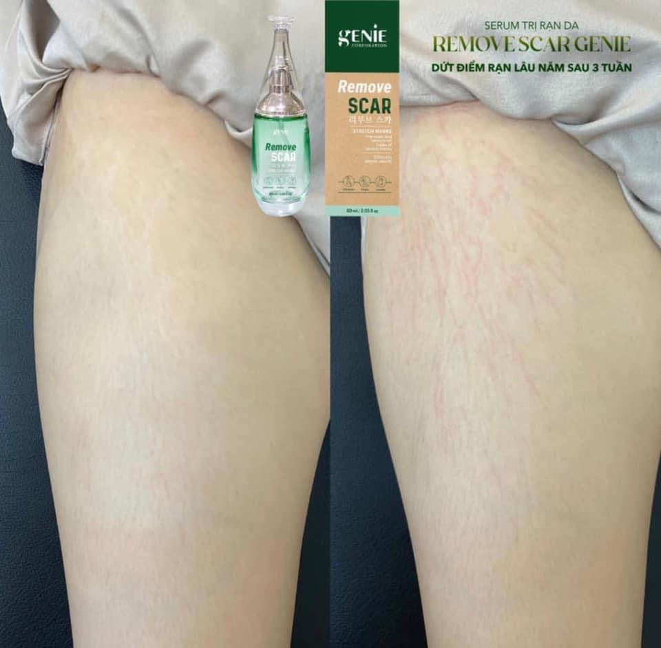 Serum tri ran da Remove Scar genie
