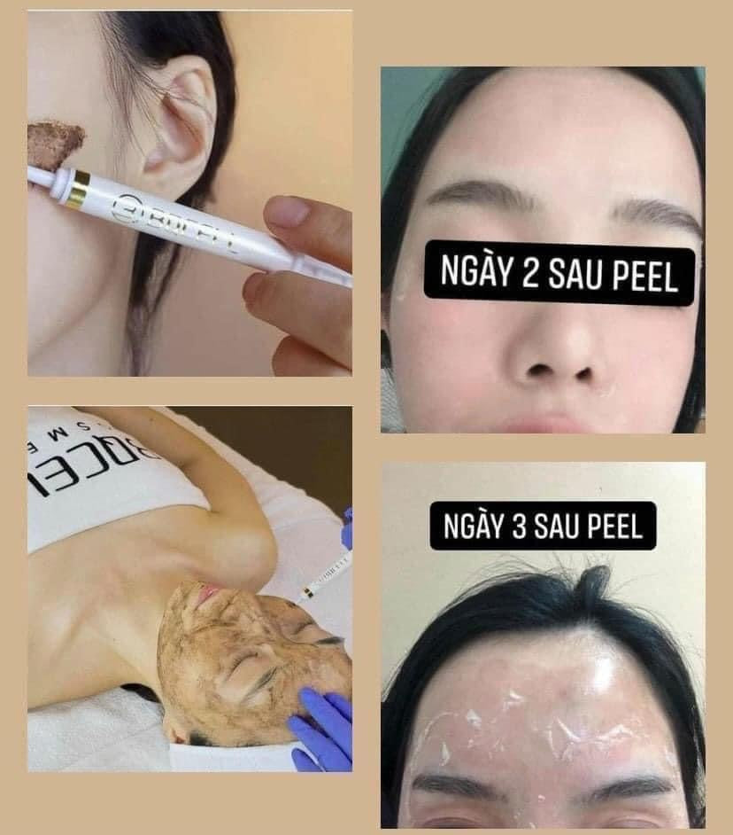 Derma skin peeling BQcell peel da ( mau moi)