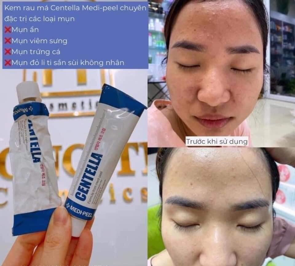 Kem tri mun phuc hoi da Centella Medipeel