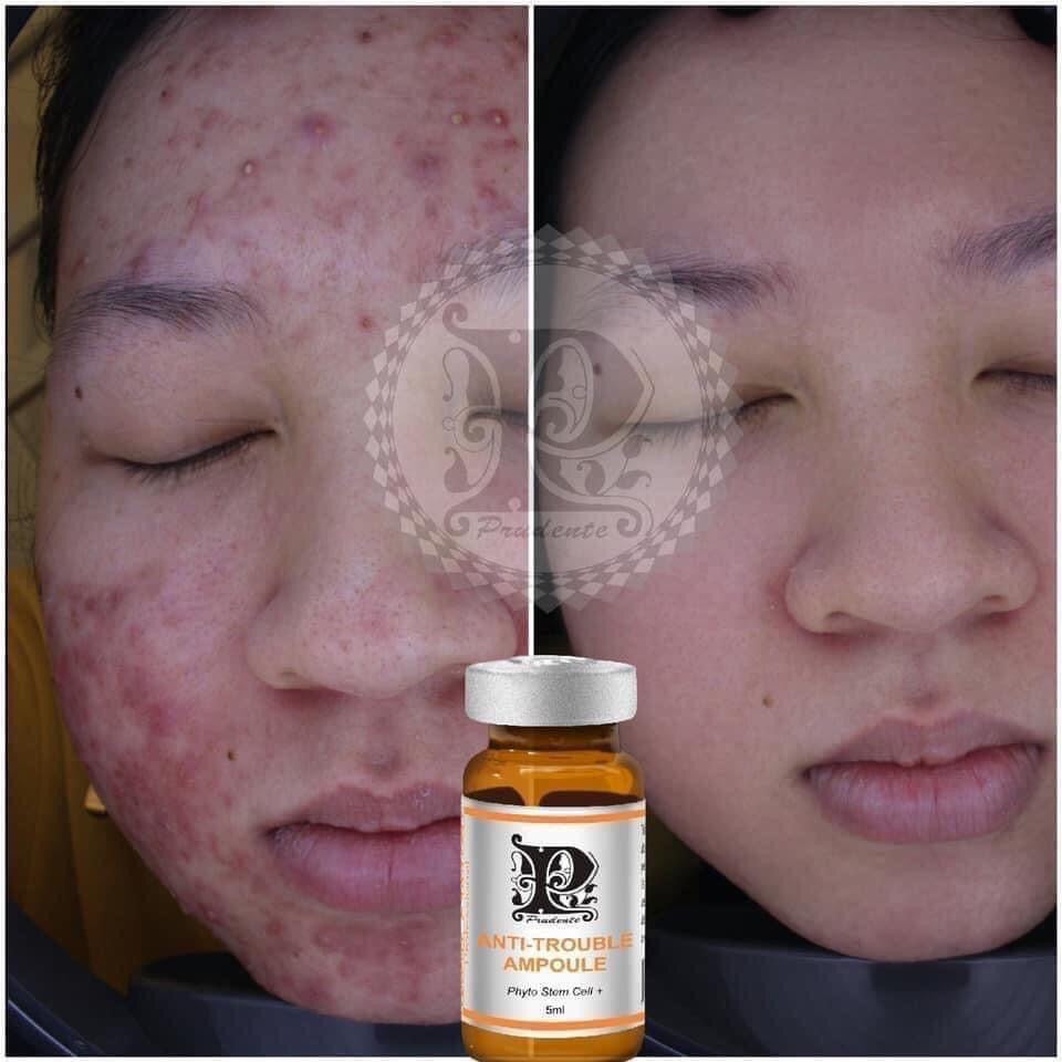 SIÊU PHẨM ĐIỀU TRỊ MỤN ANTI TROUBLE AMPOULE