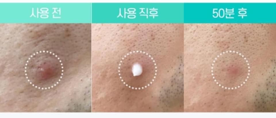 Tinh chat cham mun Cica Triple spot