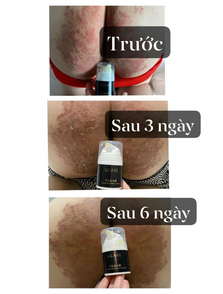 Gcare Kem viem da