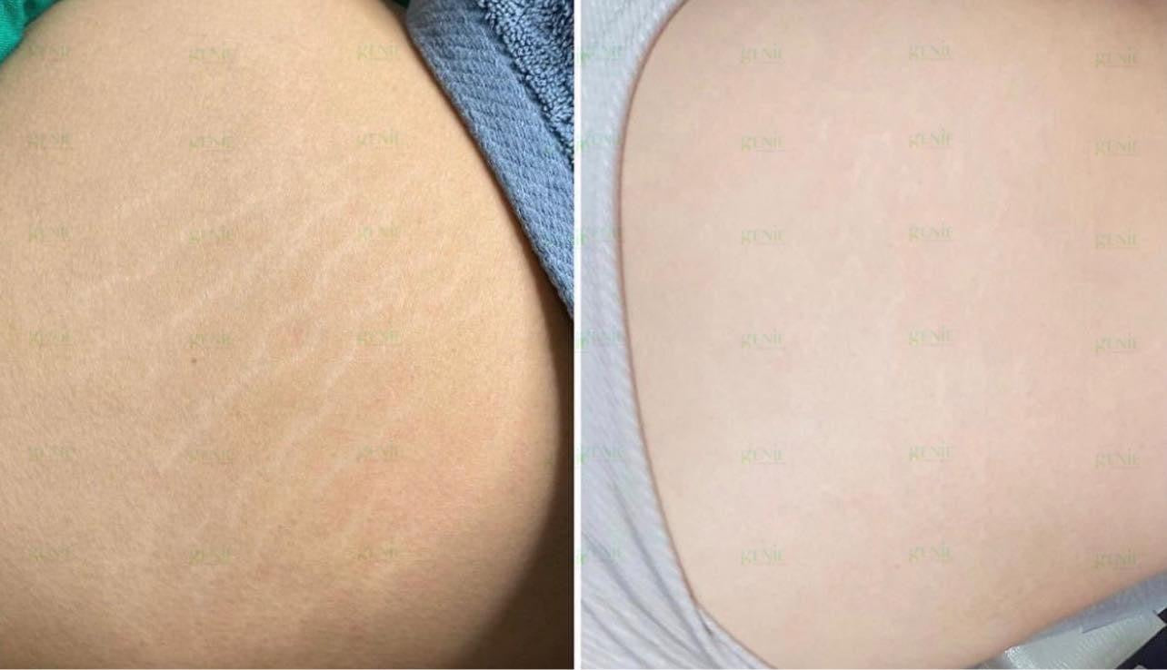 Serum tri ran da Remove Scar genie