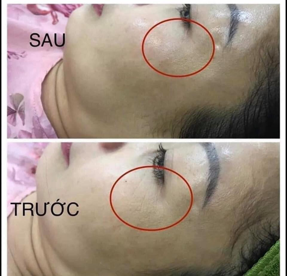 Facial Line up lifting gel (4gói)