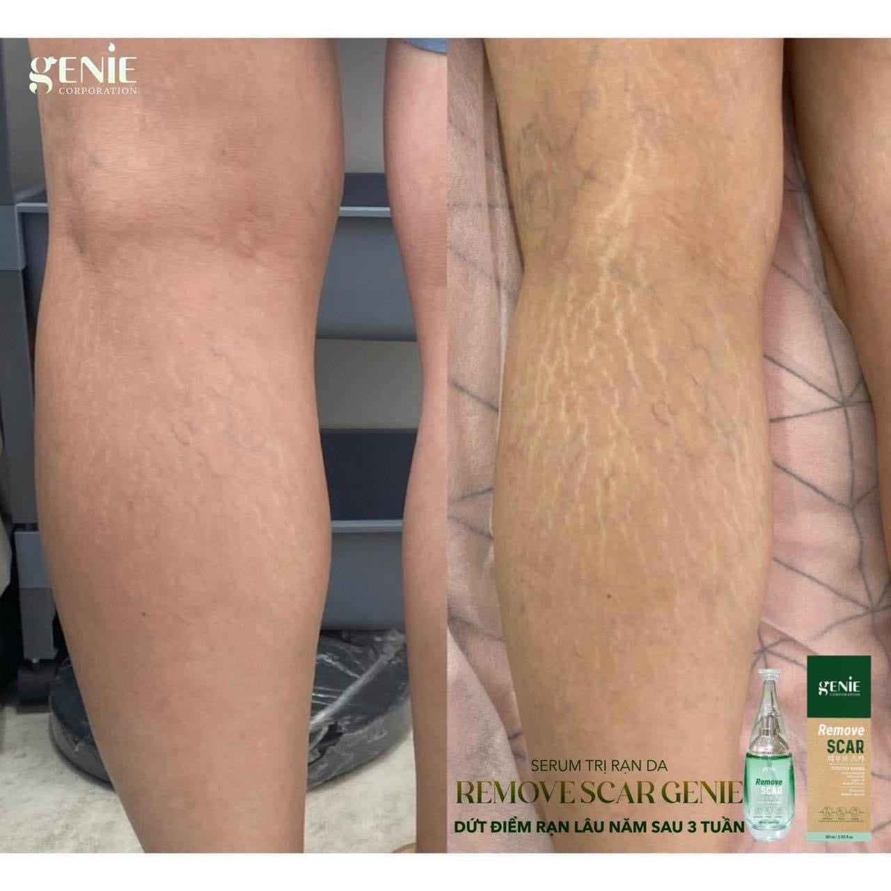 Serum tri ran da Remove Scar genie