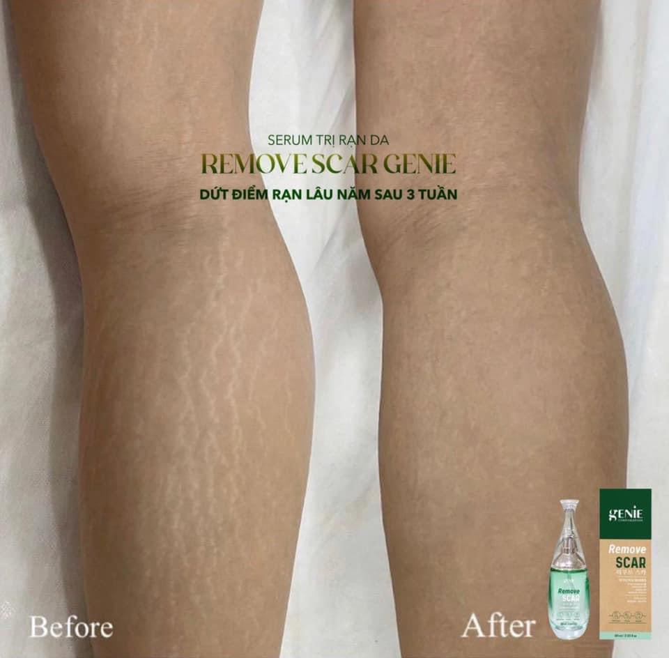 Serum tri ran da Remove Scar genie