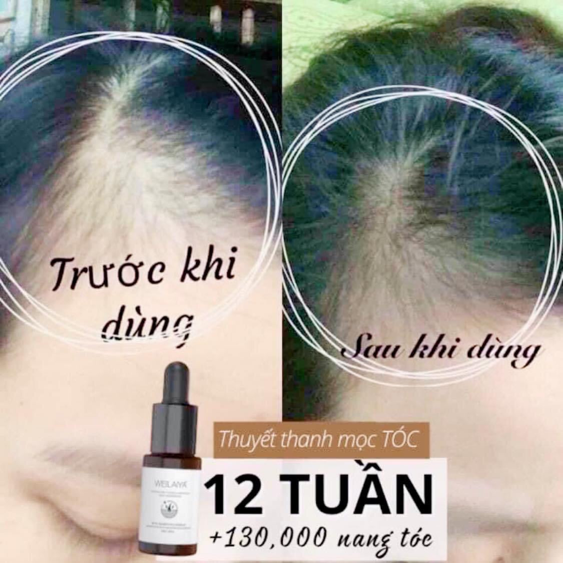 Huyet thanh moc toc weilaiya
