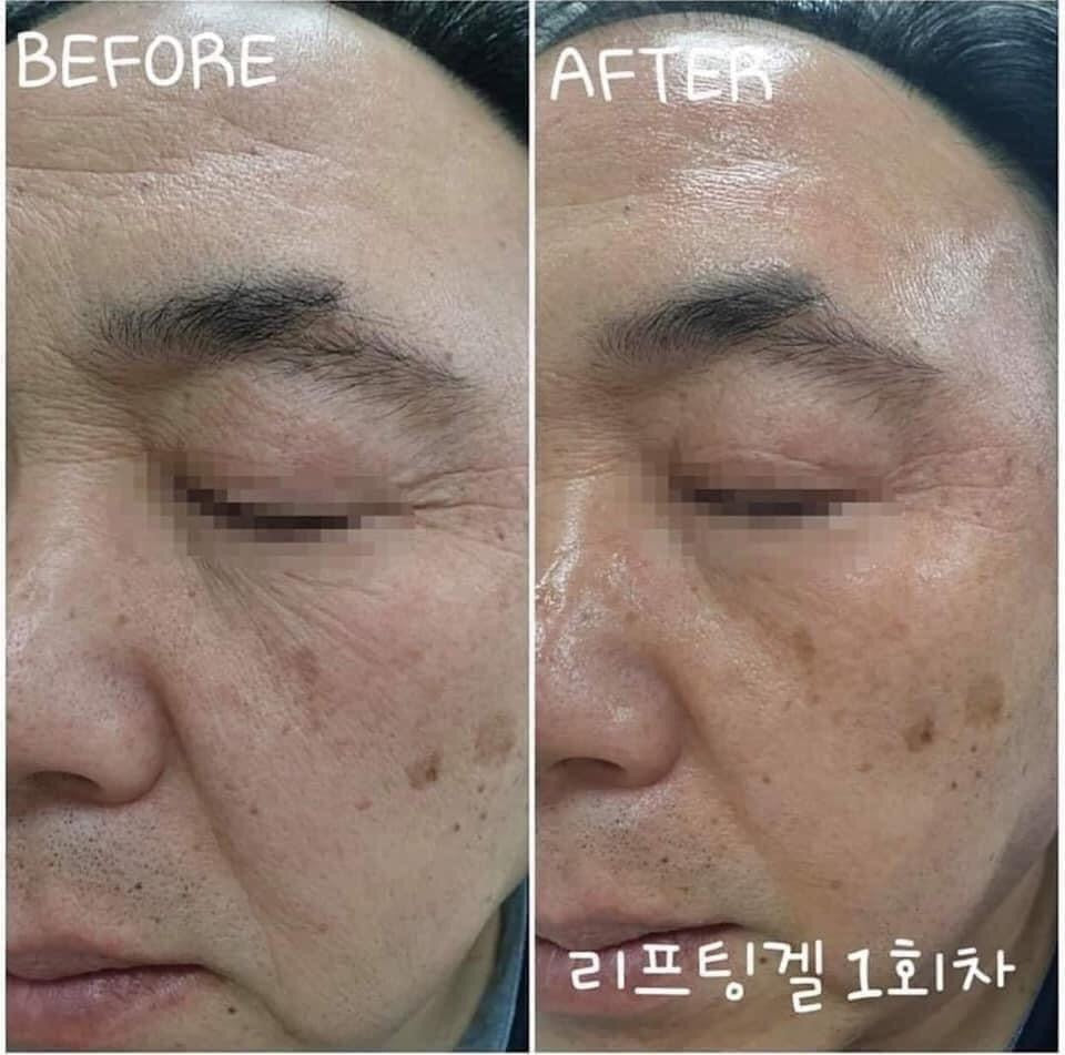 Facial Line up lifting gel (4gói)