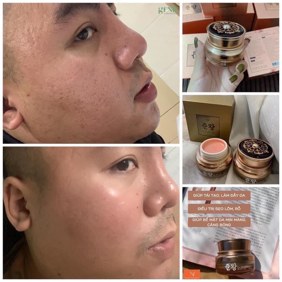 Kem tri rổ Genie SCAR- ACNE SCAR TREATMENT Korean Cream MADE IN KOREA