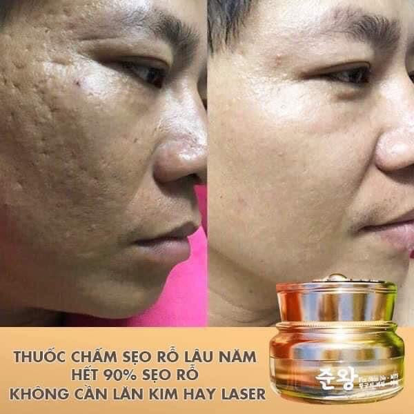 Kem tri rổ Genie SCAR- ACNE SCAR TREATMENT Korean Cream MADE IN KOREA