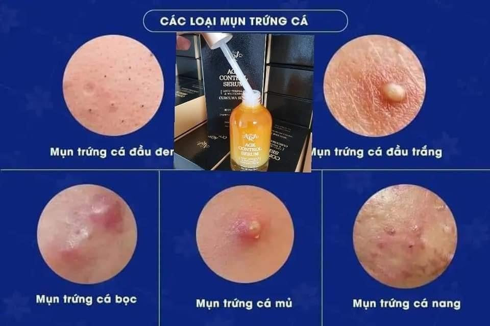Tinh chat nghe Age control serum ARA