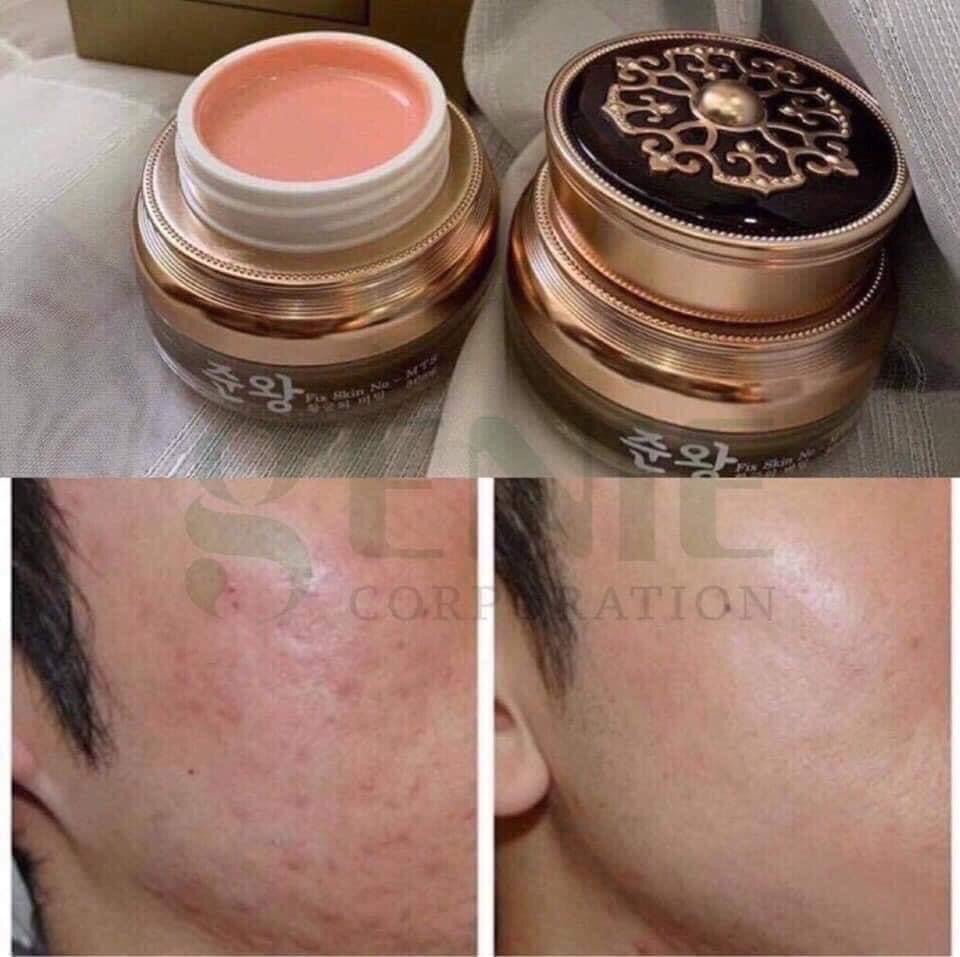 Kem tri rổ Genie SCAR- ACNE SCAR TREATMENT Korean Cream MADE IN KOREA