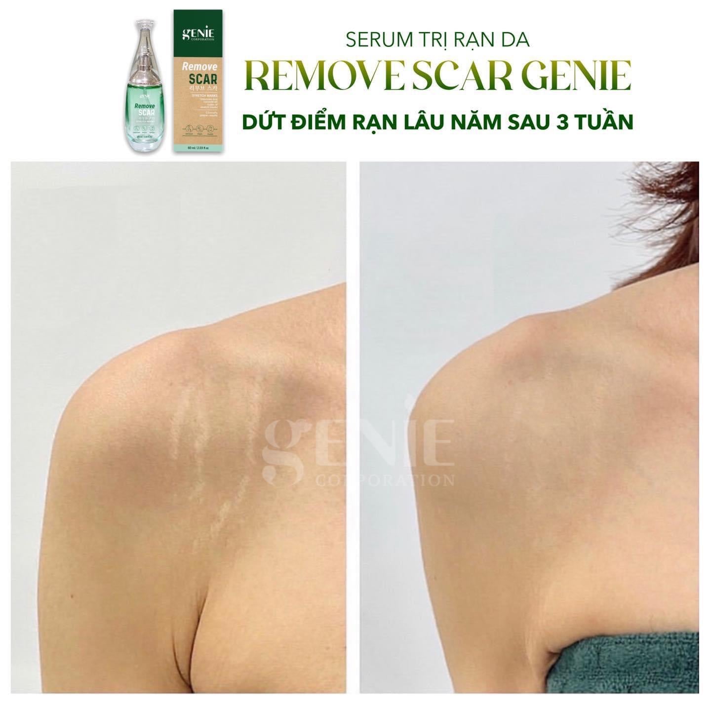 Serum tri ran da Remove Scar genie