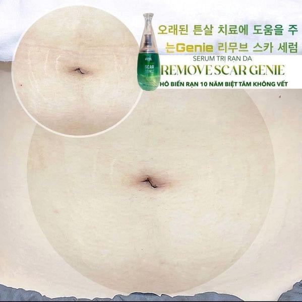 Serum tri ran da Remove Scar genie