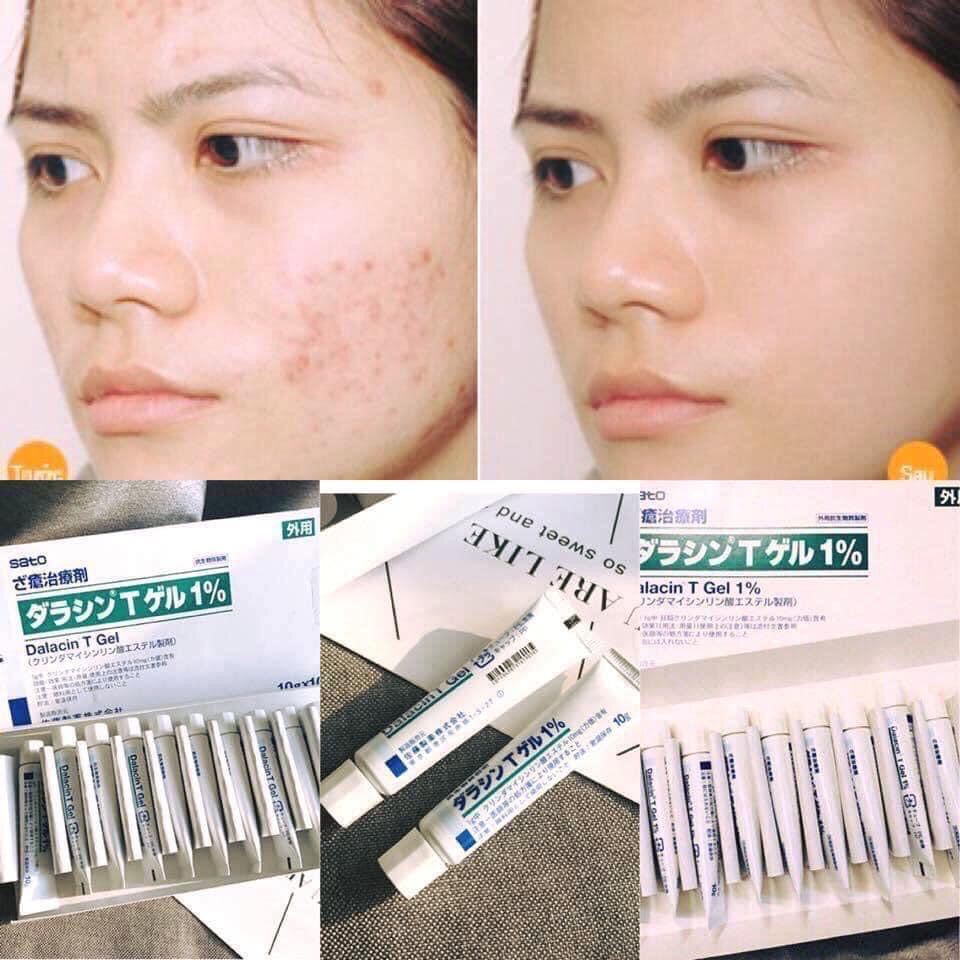 kem tri mun ( 2 tubes)