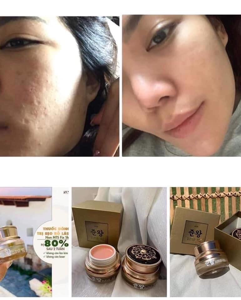 Kem tri rổ Genie SCAR- ACNE SCAR TREATMENT Korean Cream MADE IN KOREA