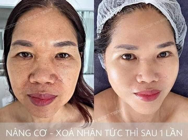 Facial Line up lifting gel (4gói)