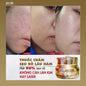 Kem tri rổ Genie SCAR- ACNE SCAR TREATMENT Korean Cream MADE IN KOREA